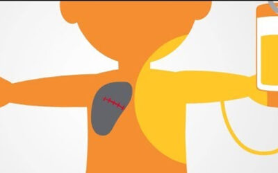 Cancer Treatment: Chemotherapy